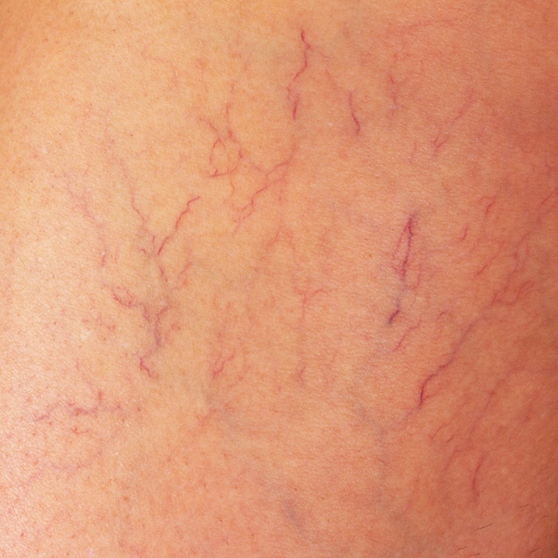 beauty-science-vasular-red-vein-e1595382589351