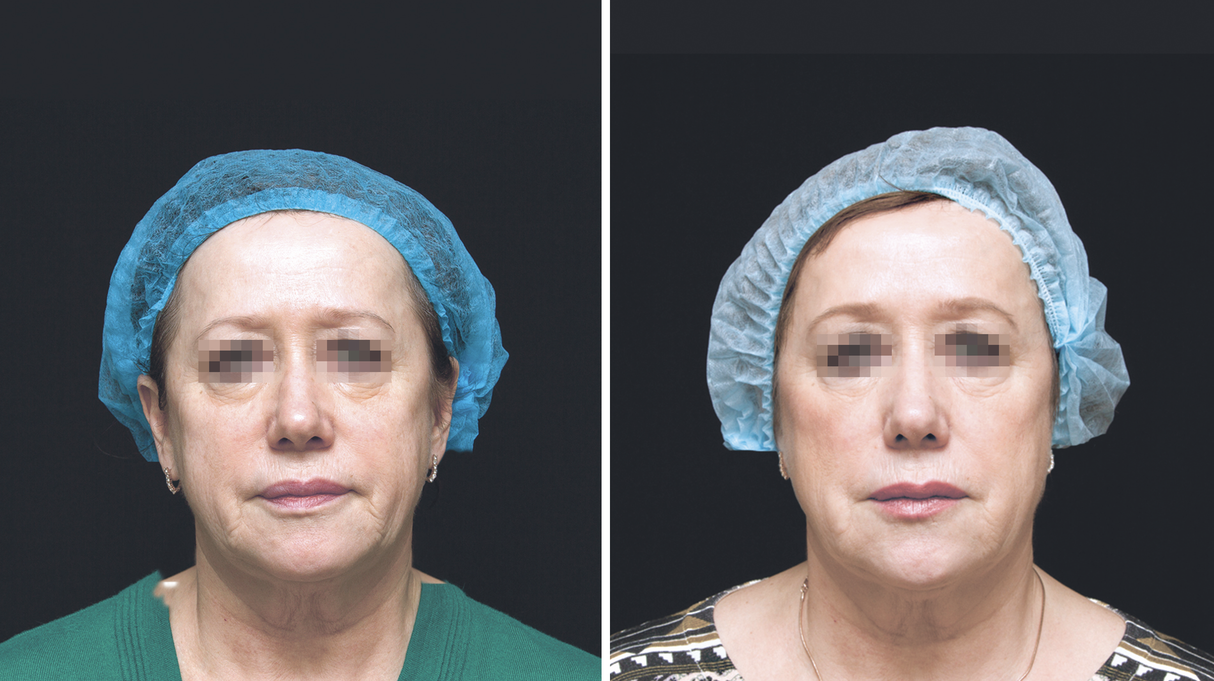 Beauty-Science-Multilevel-BioRemodelling-Treatment-before-after1