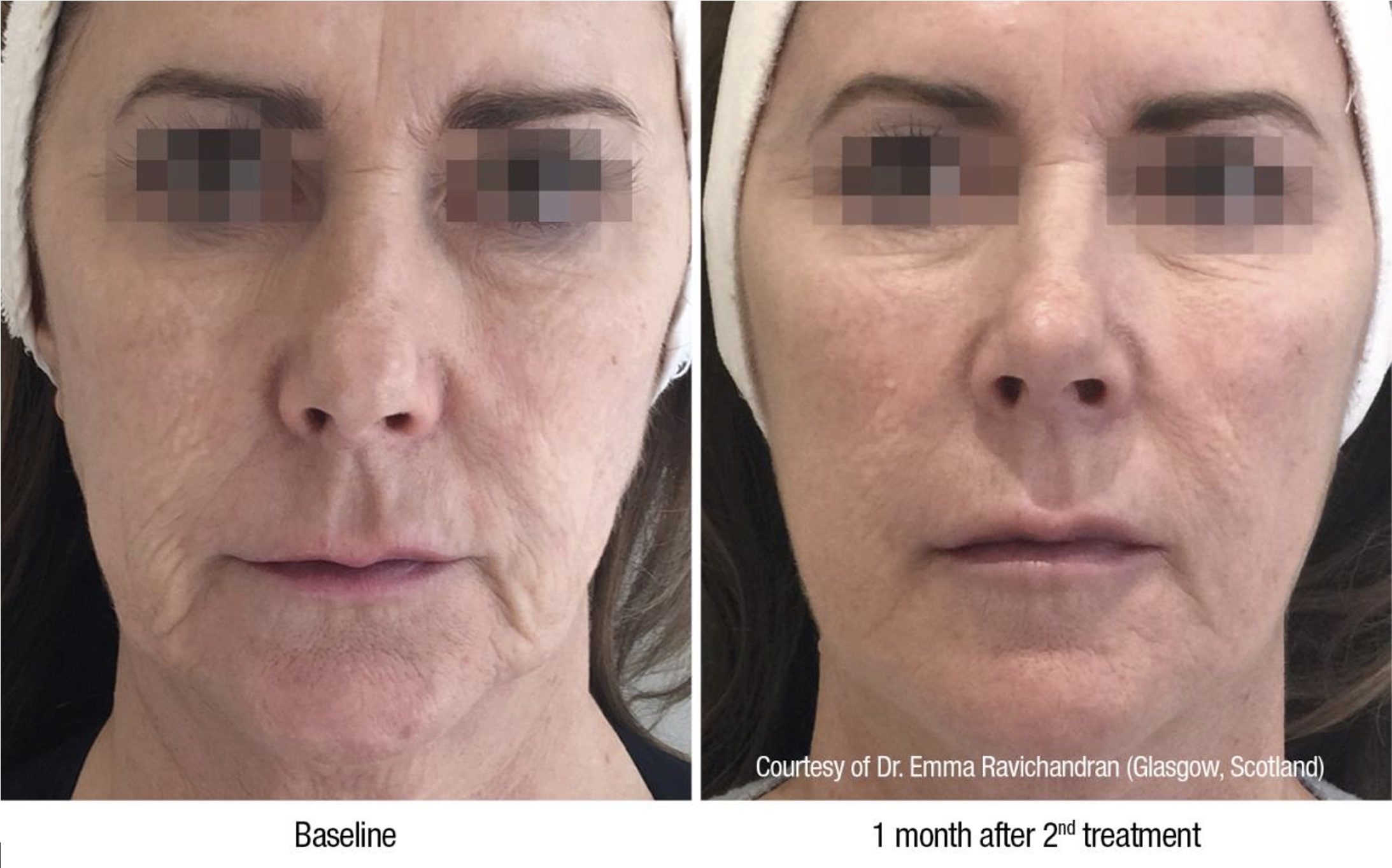 Beauty-Science-Multilevel-BioRemodelling-Treatment-before-after2