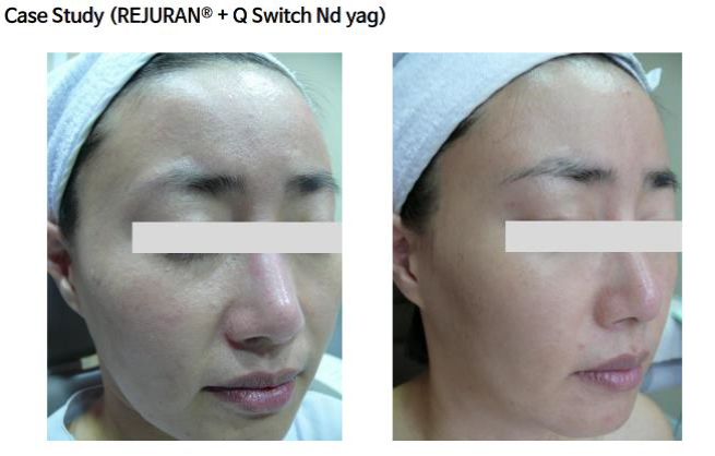 Beauty Science Richmond Rejuran Before After 1