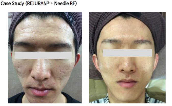 Beauty Science Richmond Rejuran Before After 2