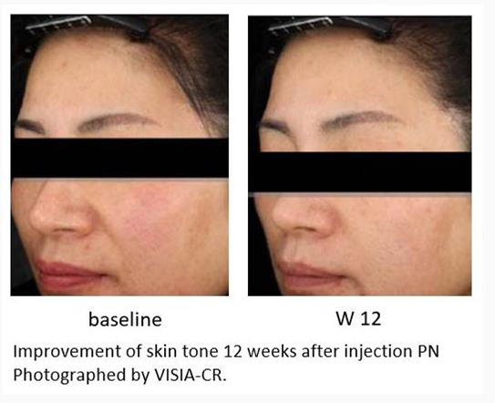 Beauty Science Richmond Rejuran Before After 3