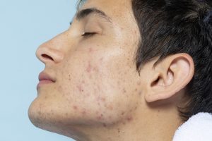 Male model with acne highlighting skin concerns discussed in What is Acne? blog post.