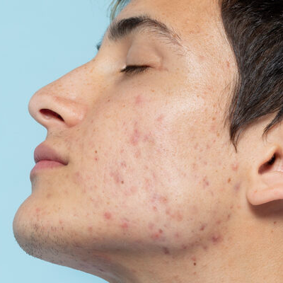 Beauty-Science-Richmond-Acne-Scar-Treatment Close-up of a person's profile showing acne scars and skin imperfections for treatment insights.