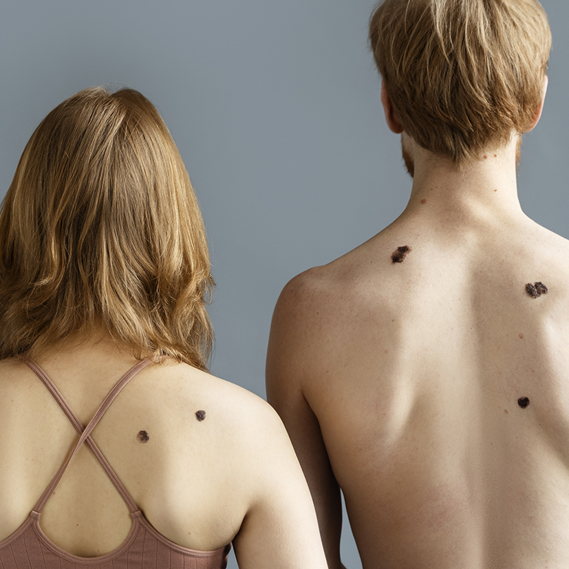 Beauty Science Skin Solutions Skin Tag Mole Lesion Removal Couple showcasing skin solutions for mole and lesion removal on backs.