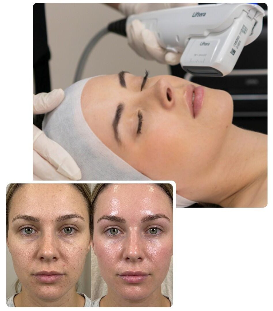 Healthy Glow with Laser Genesis