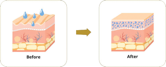 Profhilo Treatment Exposure